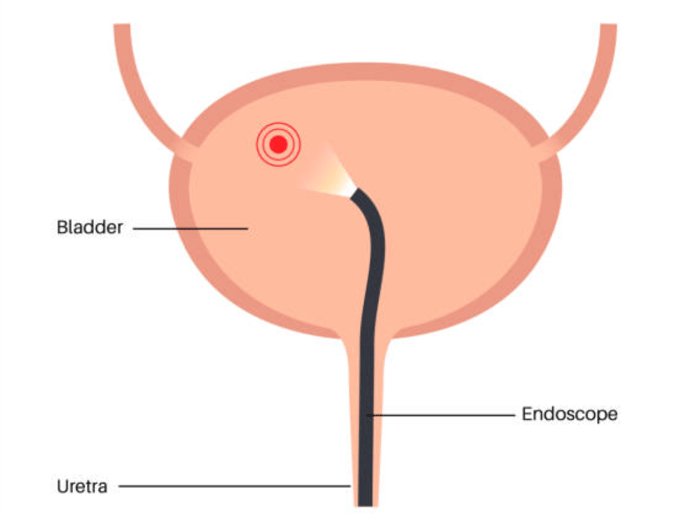 Simple illustrated cystoscopy diagram