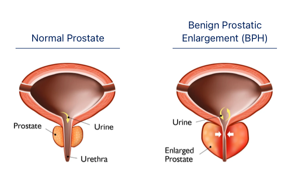 fpo-patient-wbp-bph-image-1 fpo-patient-wbp-bph-image-1